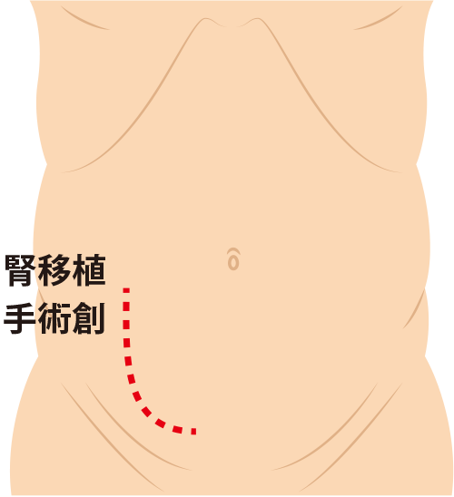 移植手術時の手術創